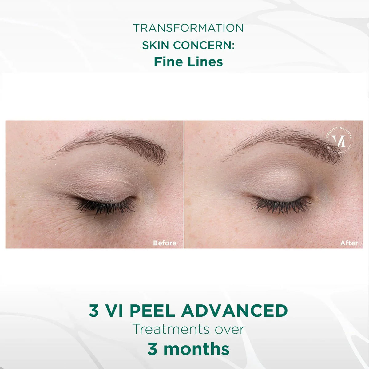 VI Peel Advanced (Full Kit) Exp 01/2028 -Authentic
