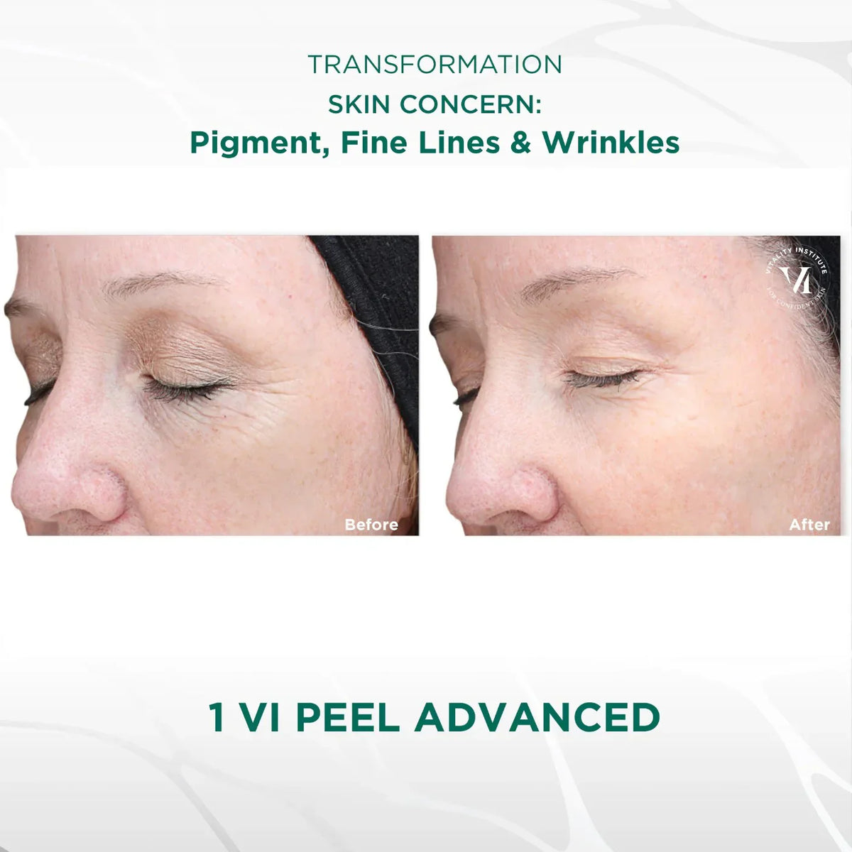 VI Peel Advanced (Full Kit) Exp 01/2028 -Authentic