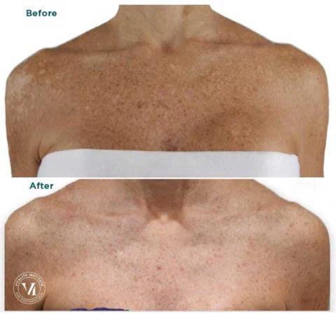 VI-Peel Body Kit (Small/Medium 4ML) -Authentic Exp. 12/2027