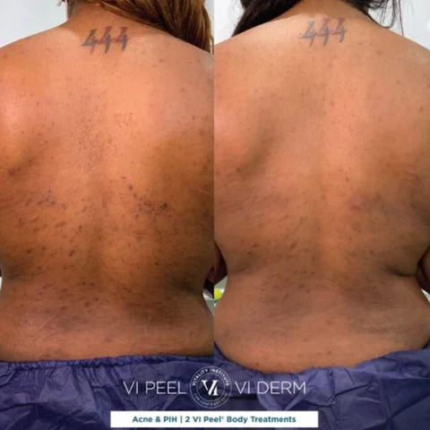 VI Peel Body (Large size 8ML) Exp 12/2027