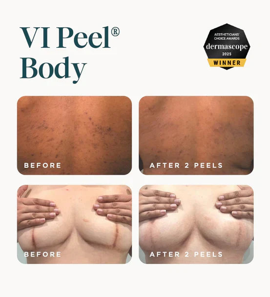 VI Peel Body (Large size 8ML) Exp 12/2027